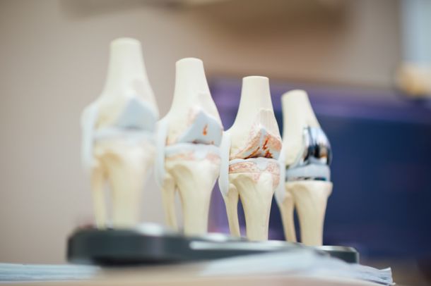 Surgical view of knee bone during osteotomy realignment procedure