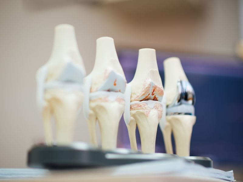 Surgical view of knee bone during osteotomy realignment procedure