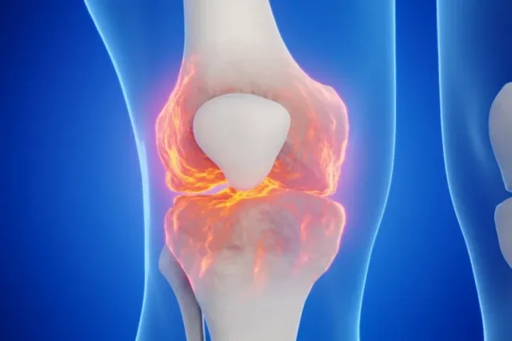 Illustration of a knee joint with damage highlighted across the joint surfaces