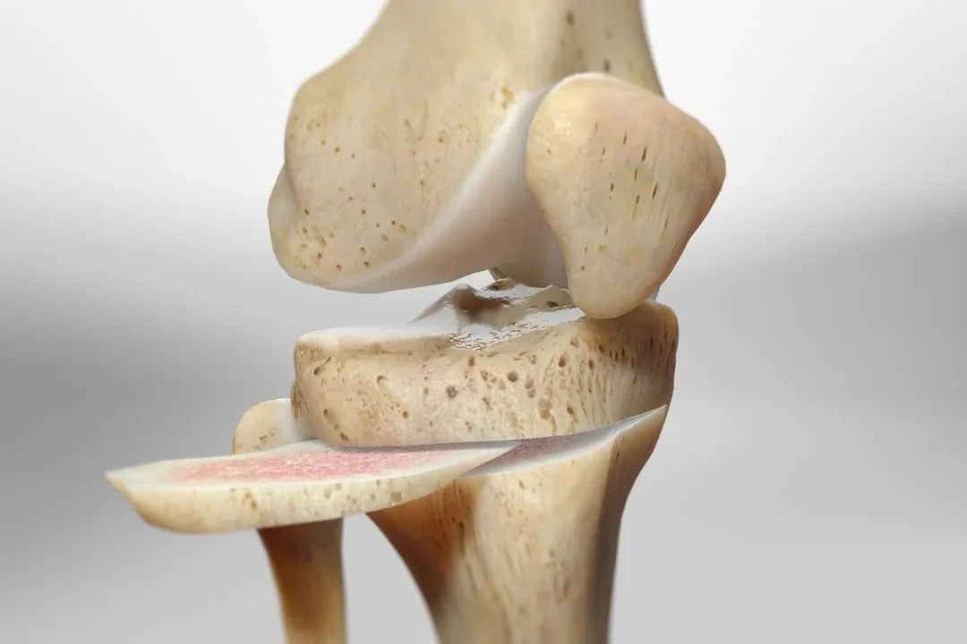 Knee osteotomy procedure