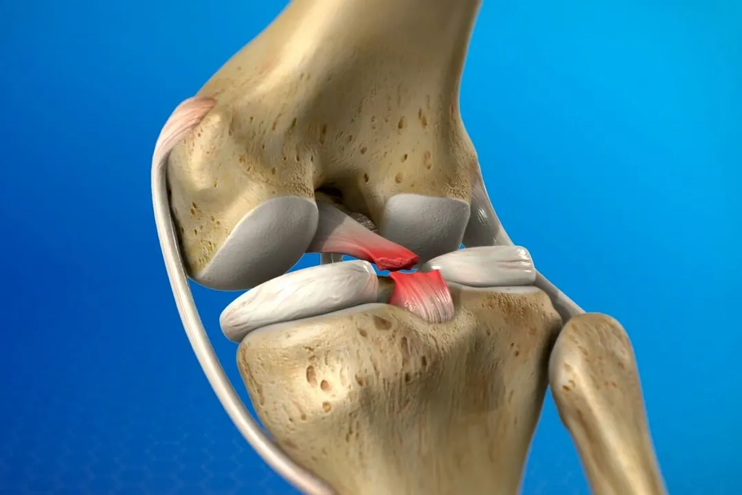 Knee ligament reconstruction surgery