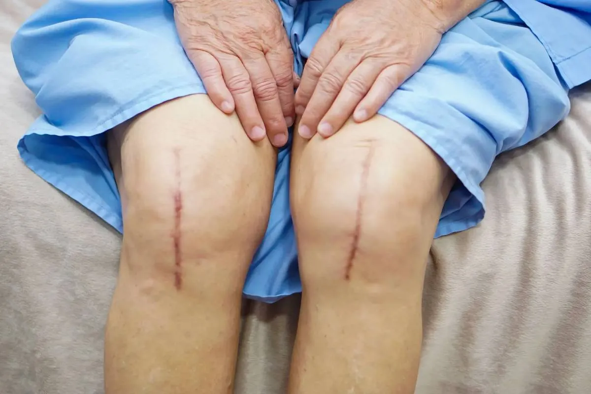 Scars on both knees several weeks after total knee replacement surgery