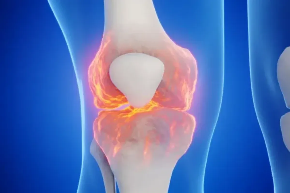 Illustration of a knee joint with damage highlighted across the joint surfaces