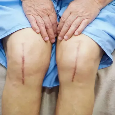 Knees showing scars after knee replacement surgery
