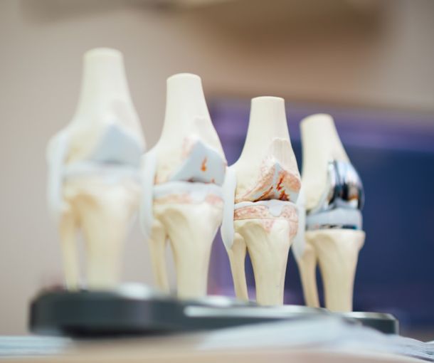 Surgical view of knee bone during osteotomy realignment procedure