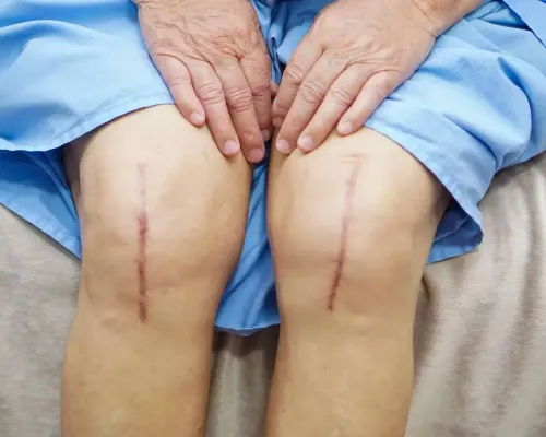 Scars on both knees several weeks after total knee replacement surgery