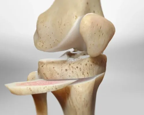 Knee osteotomy procedure