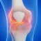 Illustration of damaged cartilage in a knee joint