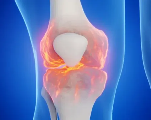 Illustration of a knee joint with damage highlighted across the joint surfaces