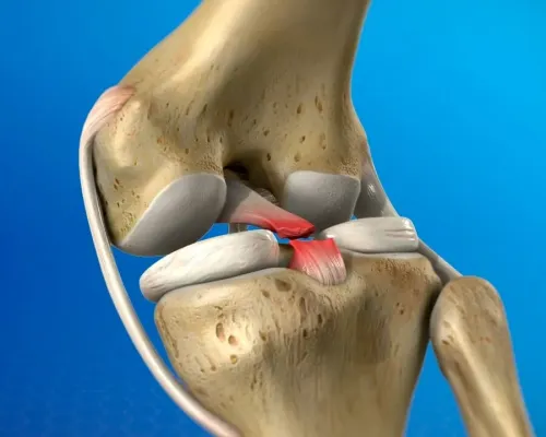 Knee ligament reconstruction surgery